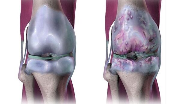 Articulația genunchiului sănătoasă și afectată de artroză