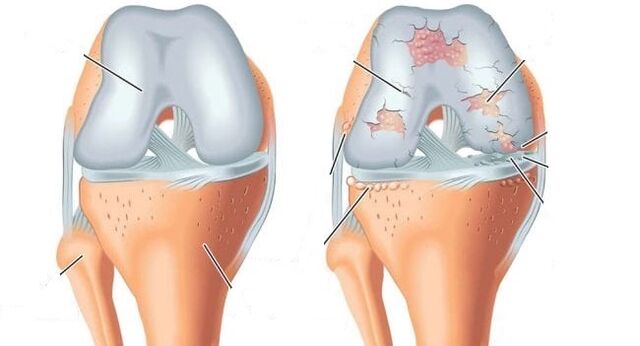 articulație sănătoasă și artroză a articulației genunchiului