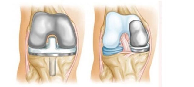artroplastie pentru artroza articulației genunchiului