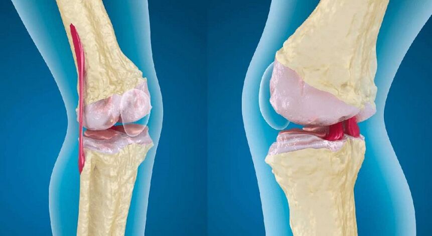 articulație sănătoasă și artroză a articulației genunchiului
