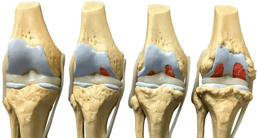 deteriorarea articulației genunchiului în diferite stadii ale dezvoltării artrozei