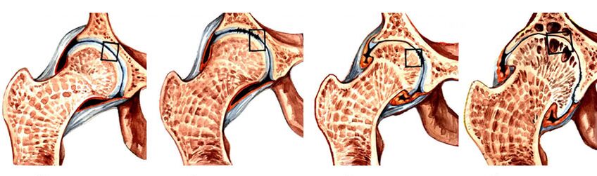 Gradul de dezvoltare a artrozei articulației șoldului