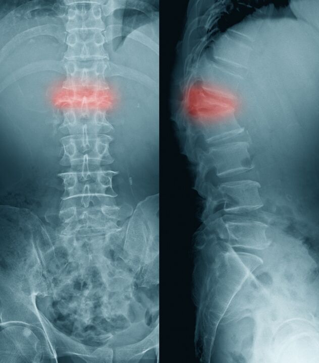 diagnosticul durerii de spate