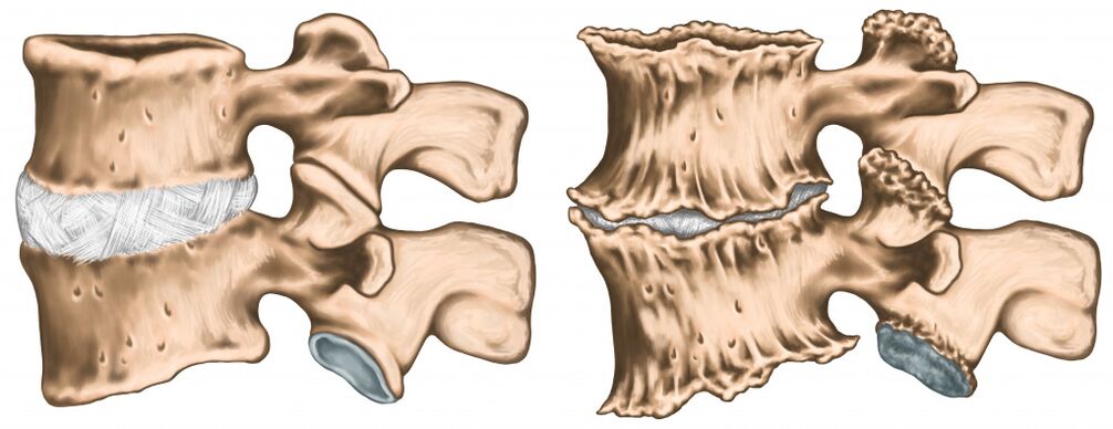 dureri de spate din cauza leziunilor coloanei vertebrale
