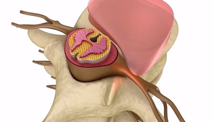 leziunea coloanei vertebrale în osteocondroza toracică
