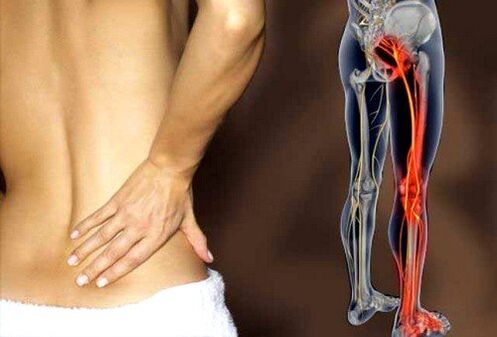 dureri de spate din cauza inflamației nervului sciatic