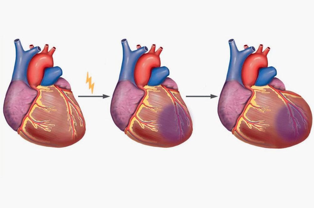 Infarctul miocardic duce la durere la nivelul omoplaților