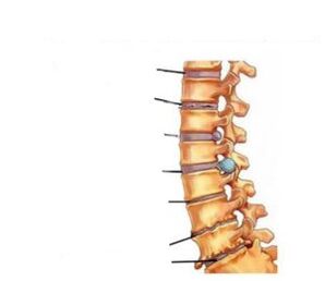 Simptome de osteochondroză