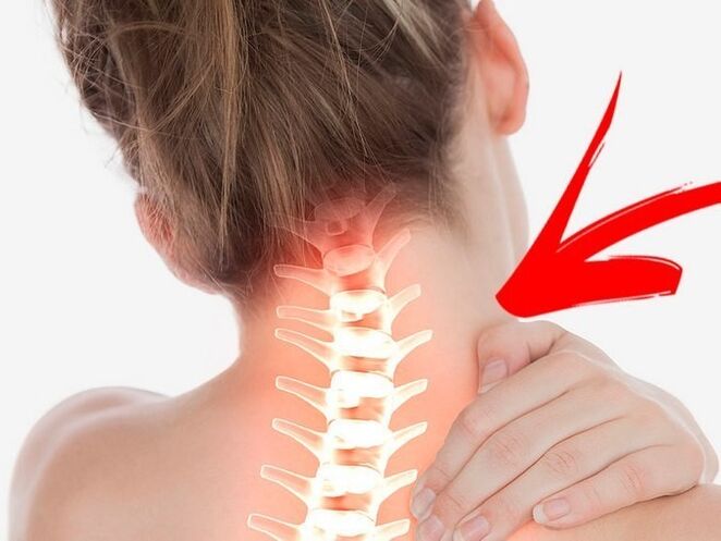 Compresia rădăcinilor nervoase cu osteocondroză cervicală