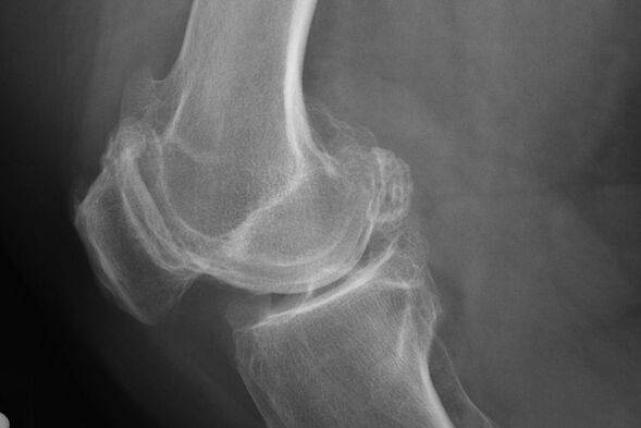 Metode de diagnosticare a artrozei la genunchi