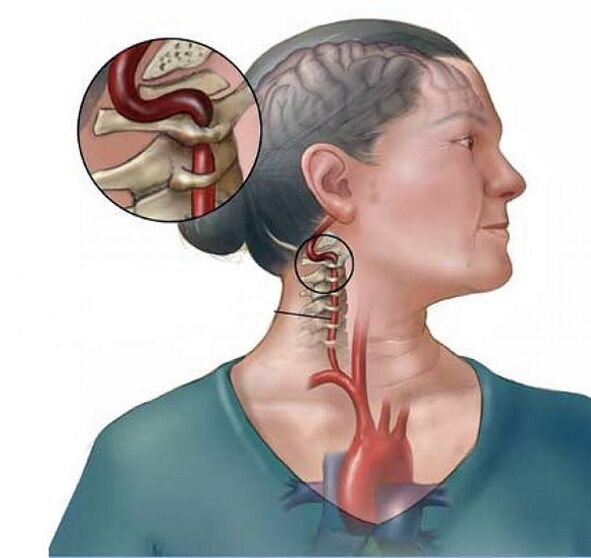 sindromul arterei vertebrale cu osteocondroză cervicală
