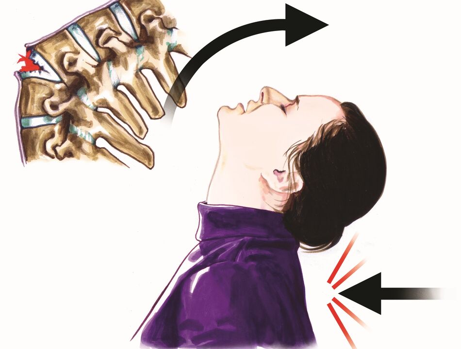 afectarea coloanei vertebrale ca cauză a durerii de gât