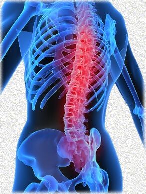 osteocondroza și metodele de tratament ale acesteia